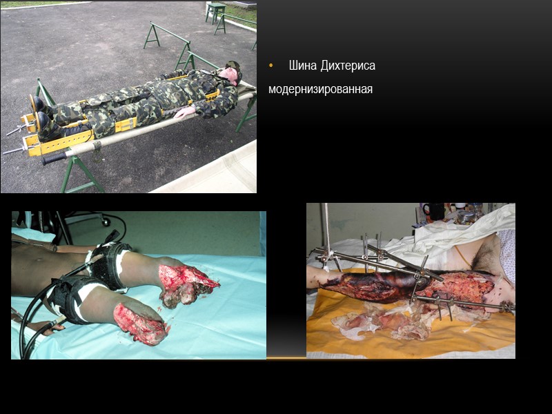 Шина Дихтериса  модернизированная